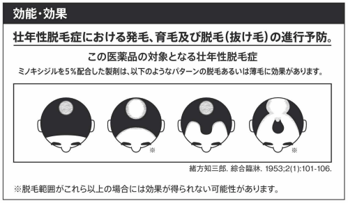 male-pattern-baldness